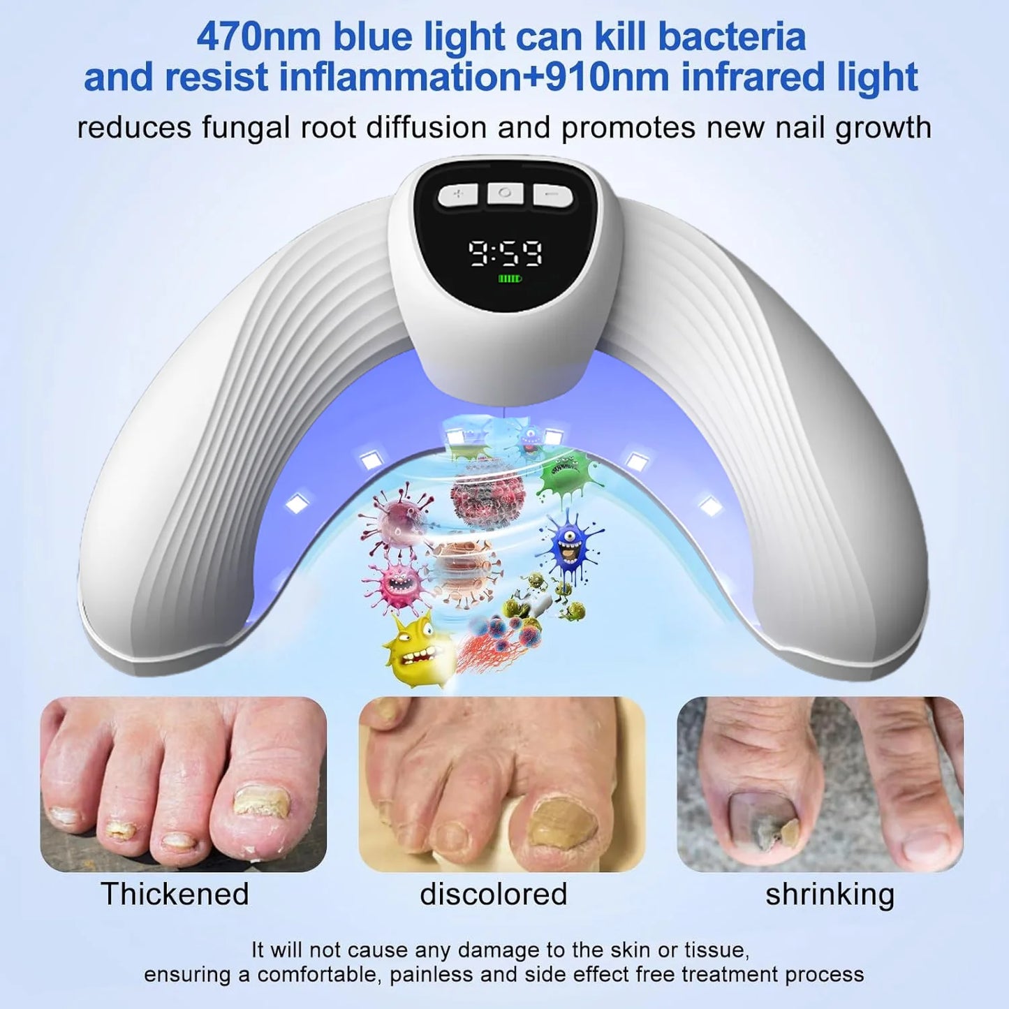 Laser Nail Fungus Treatment Device –for Onychomycosis/Fungal Infections