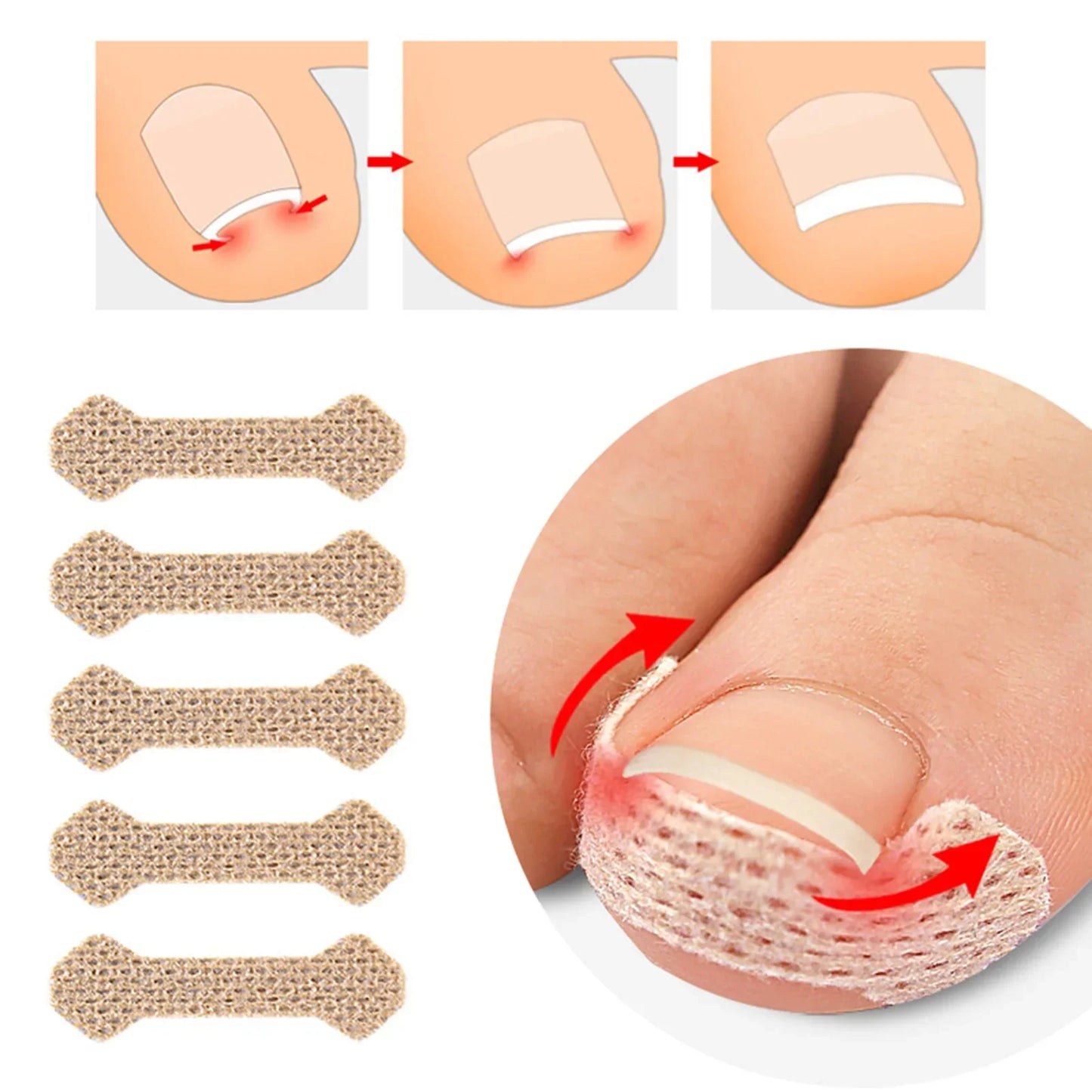 Ingrown Toenail Corrector Strips