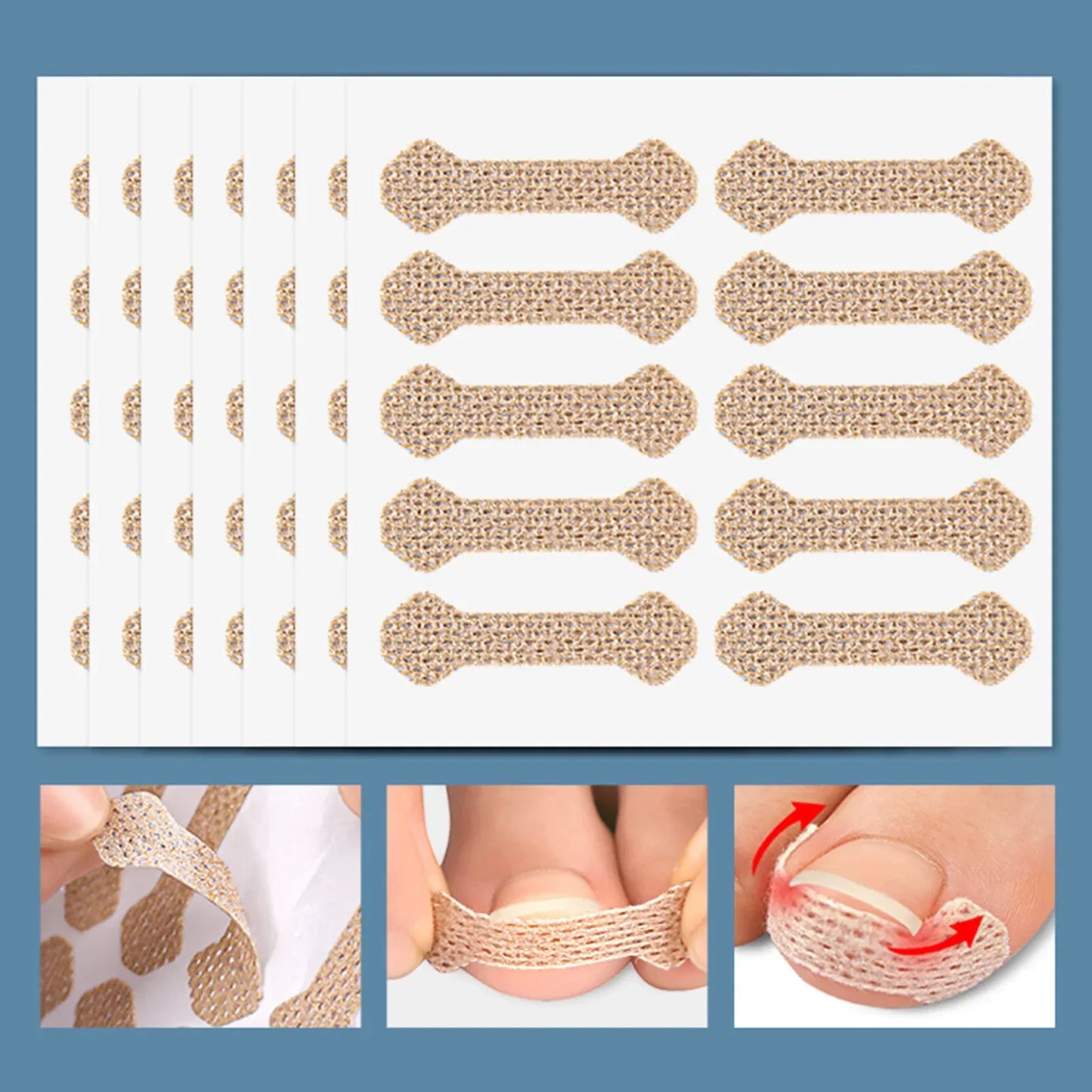 Ingrown Toenail Corrector Strips