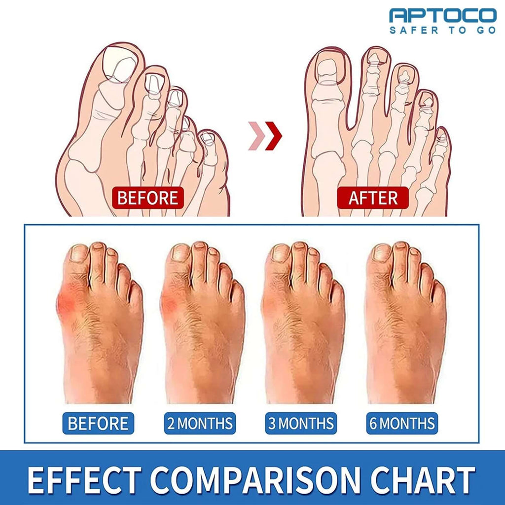 Copper Bunion Corrector, Hallux Valgus Corrector Bunion Sleeves, Pink Iolaus