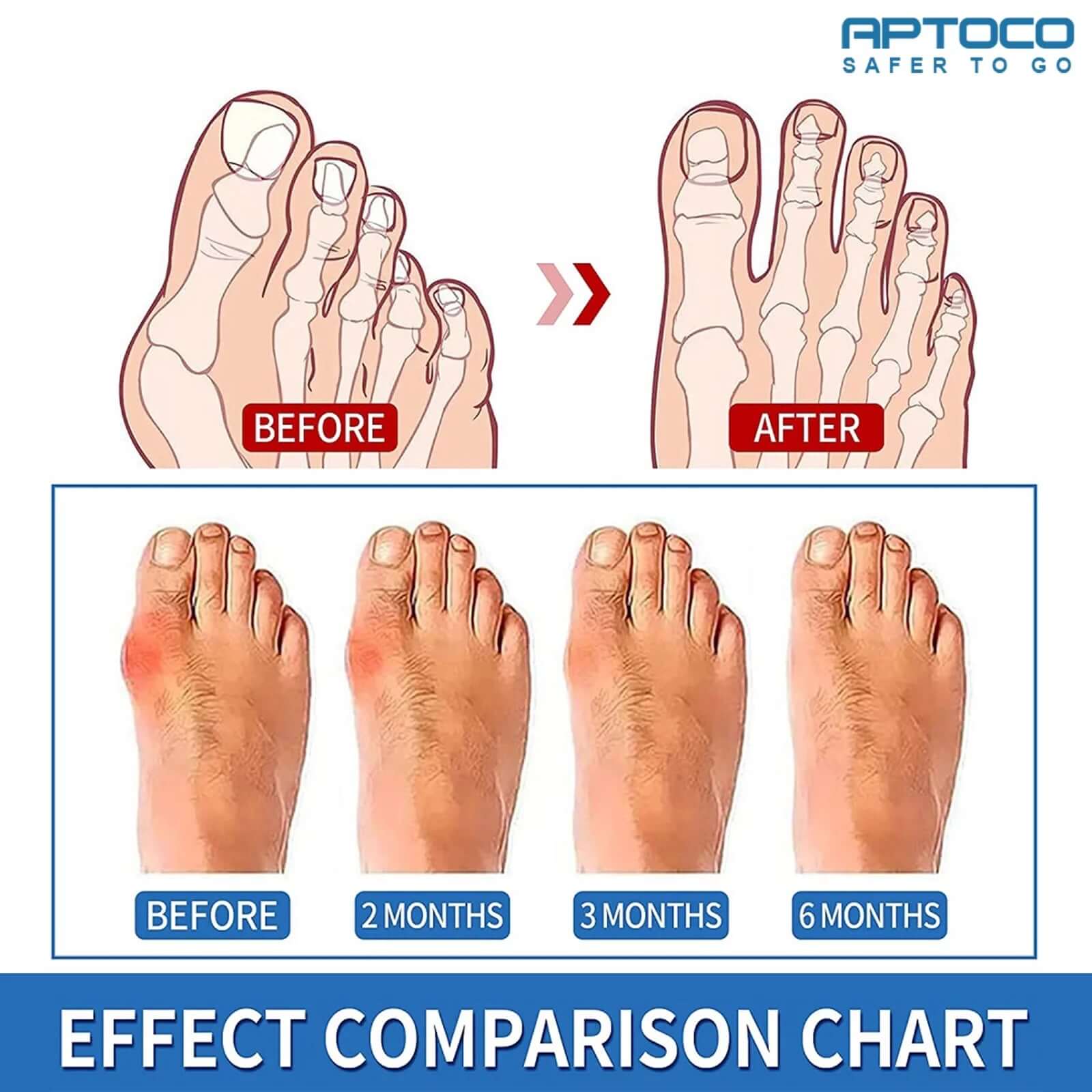 Copper Bunion Corrector, Hallux Valgus Corrector Bunion Sleeves, Pink Iolaus