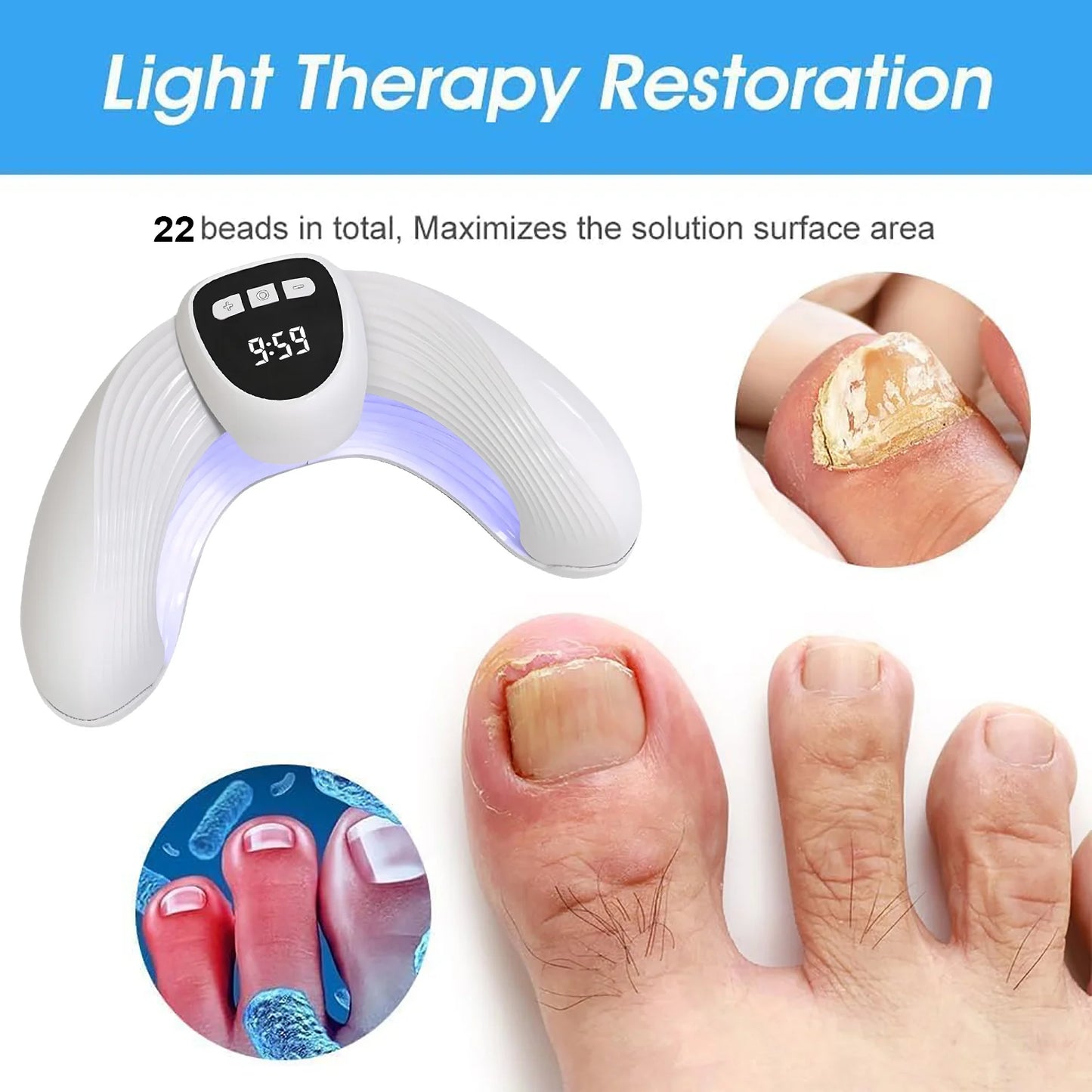 Laser Nail Fungus Treatment Device –for Onychomycosis/Fungal Infections