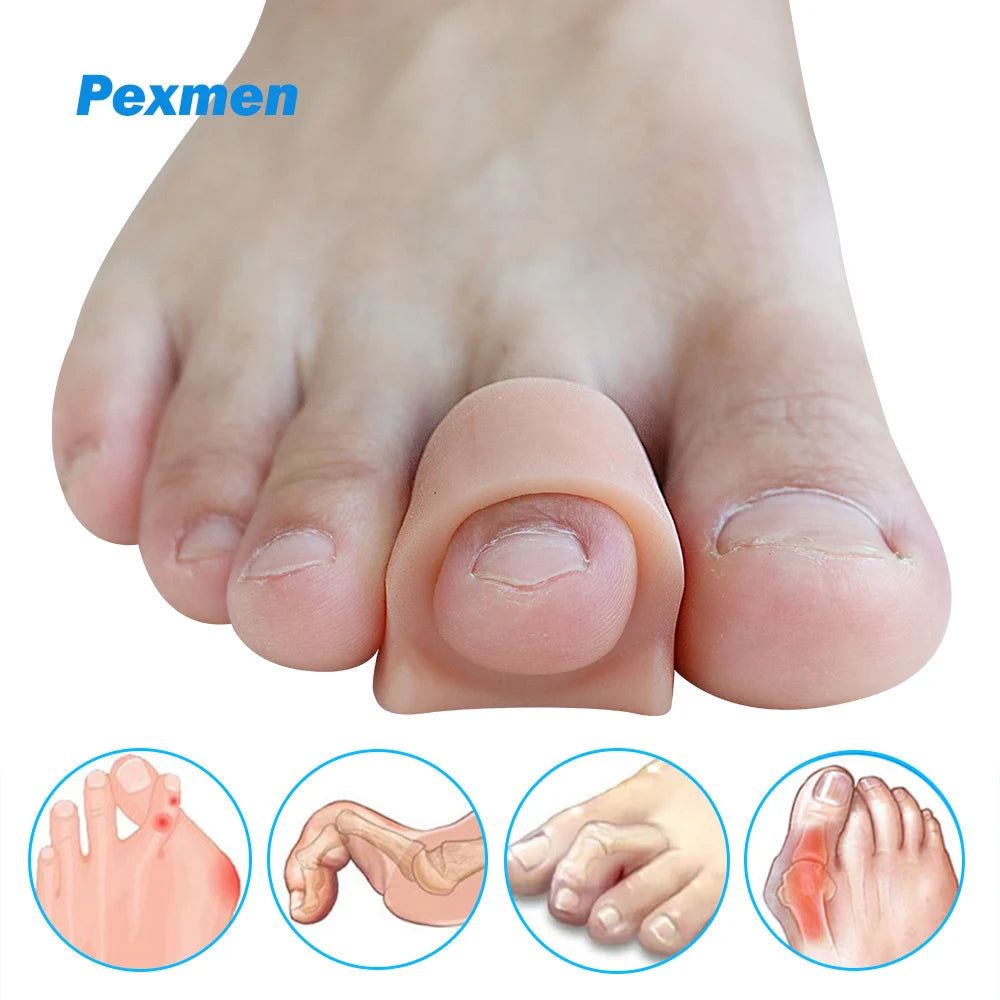Toe Spacers for Overlapping Hallux Valgus
