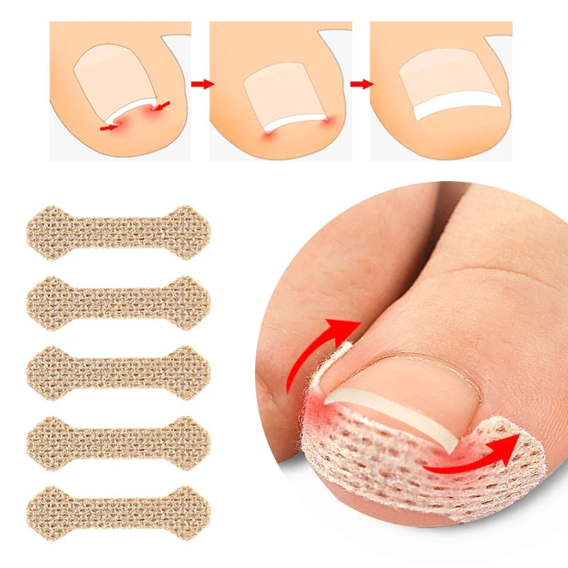 60pcs Ingrown Paronychia Toenail Corrector Strips Anti Nail Patch Feet Sleeping Nail Patch Nails Into The Flesh Long Toe Pad