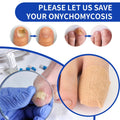 AntiFungal Toenail Patches