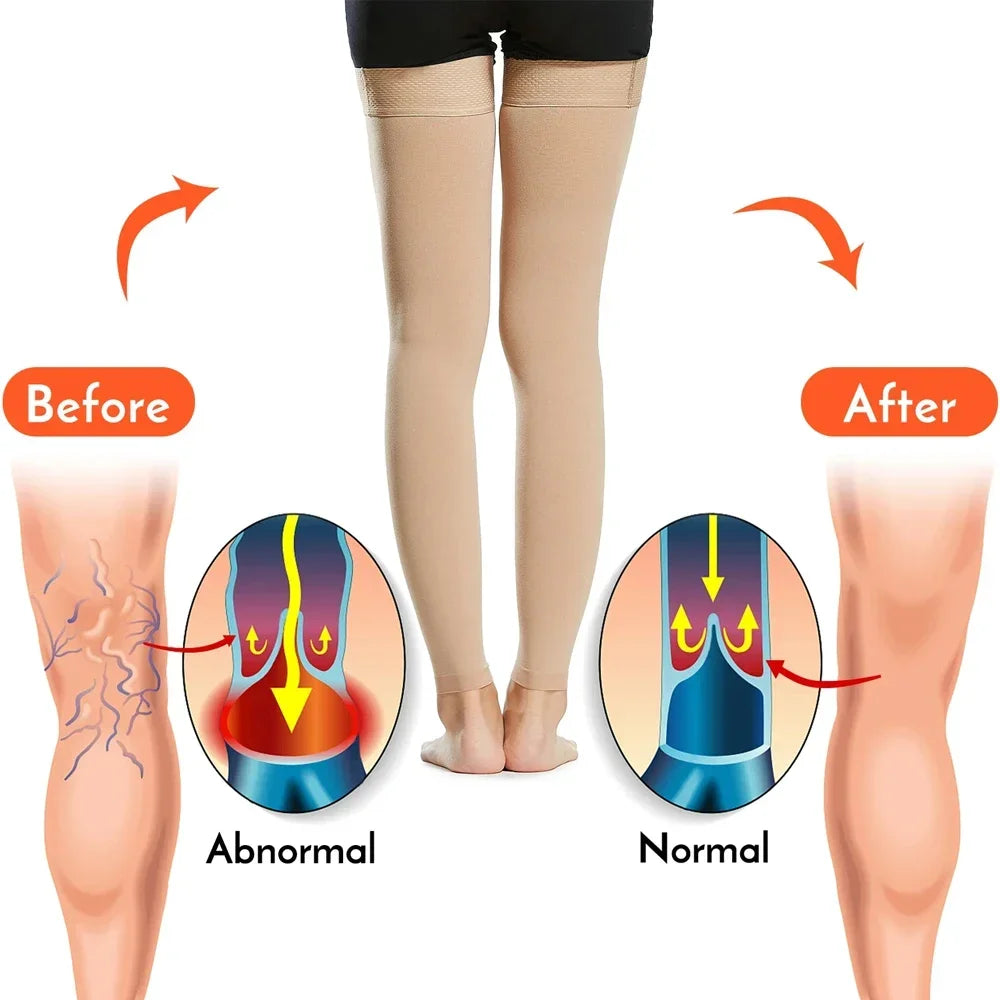 1Pair Thigh High 20-32 mmHg Compression Stocking Toeless Compression Socks for women & men circulation with Silicone Dot Band