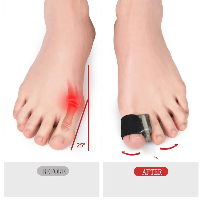 1Pair Big Bone Thumb Toe Separator Bunion Splint Straightener Corrector Foot Care Tools Hallux Valgus Protector Orthotics Thumb