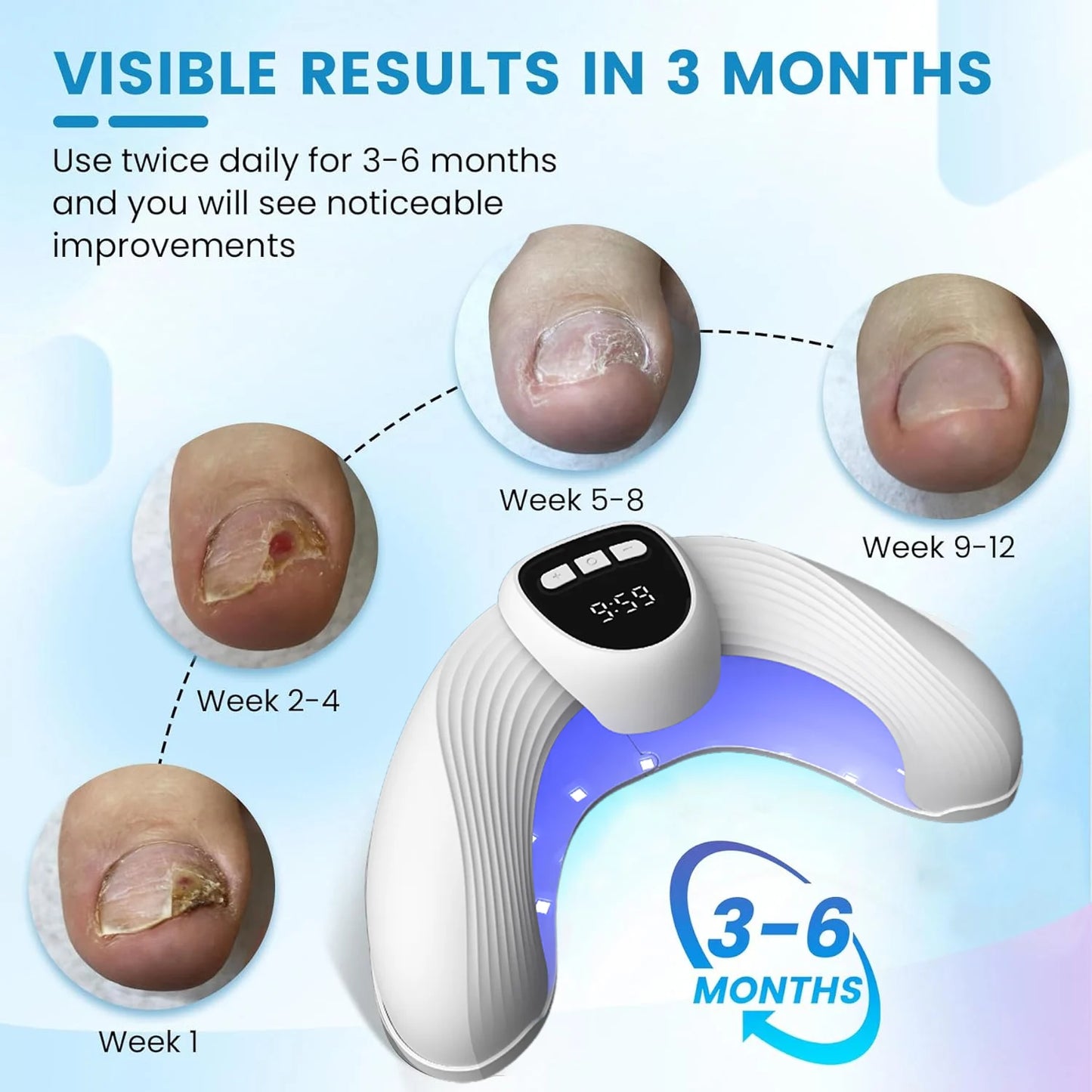 Laser Nail Fungus Treatment Device –for Onychomycosis/Fungal Infections